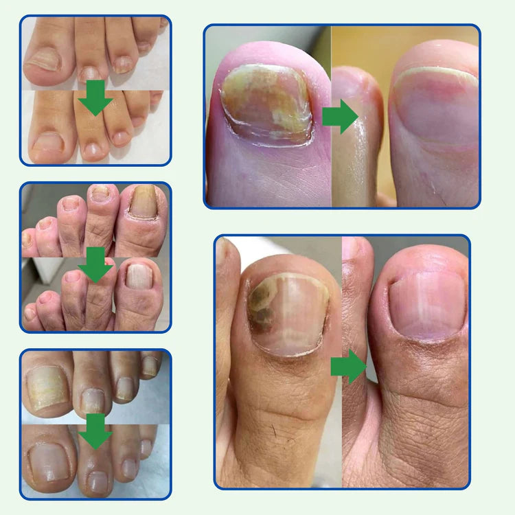 7 Days tratamiento hongos ® Protege y elimina el hongo de tus uñas