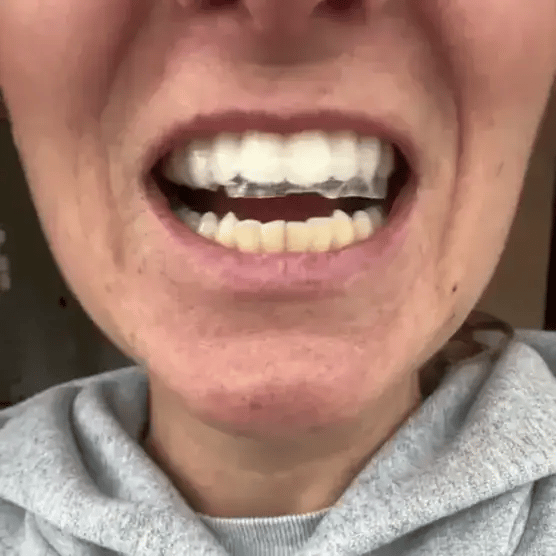 Smileon ® Tiras blanqueadoras Kit x2 Sonrisa Blanca Natural- 38% Descuento