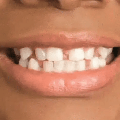 Carillas Dentales Premium pague 1 lleve 2 ® - Perfecto para muecos & dientes amarillos